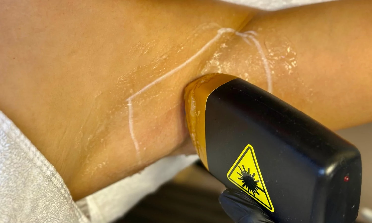 Laserontharing-behandeling